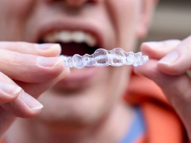 How Does Invisalign Work on Crowded Teeth?