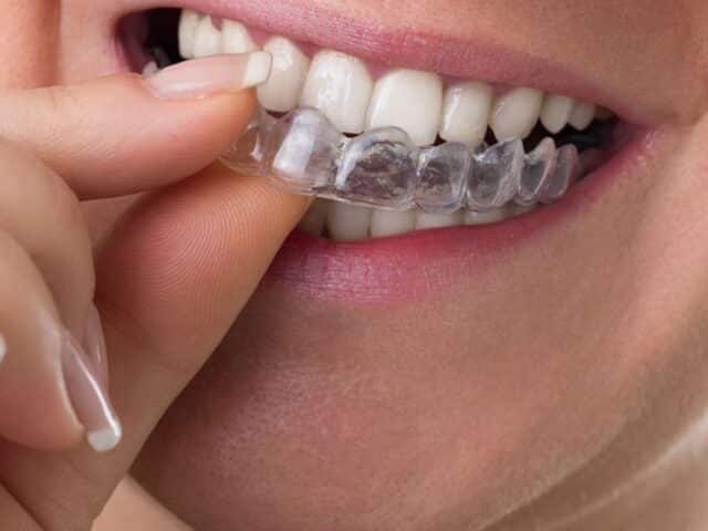Give Yourself a Straighter Smile This Christmas with Invisalign