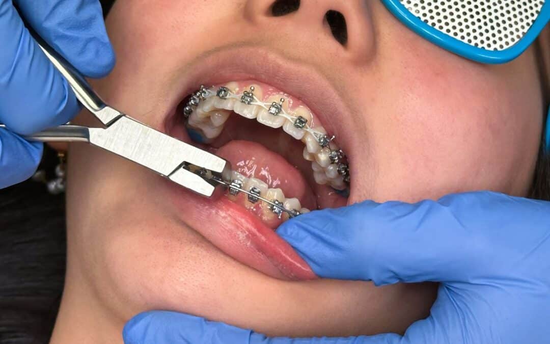 Why Do My Gums Bleed More Since Getting Braces?