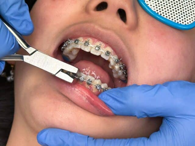 Why Do My Gums Bleed More Since Getting Braces?