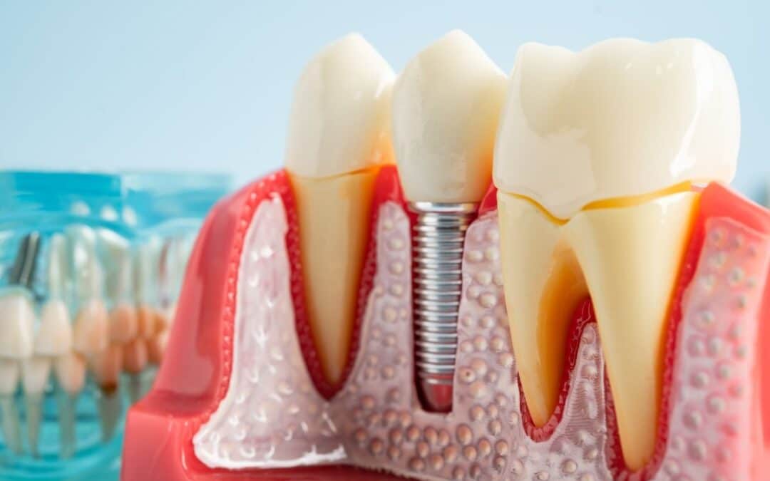 Do Seniors Heal Slower from Dental Implant Surgery?