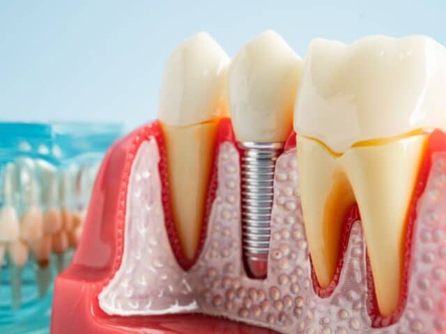 Do Seniors Heal Slower from Dental Implant Surgery?