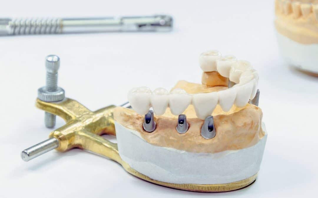 How Do I Choose the Right Dentist for Dental Implants?