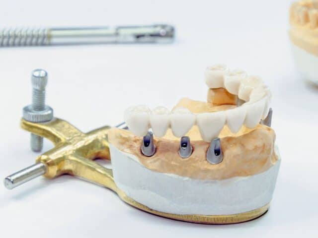 How Do I Choose the Right Dentist for Dental Implants?