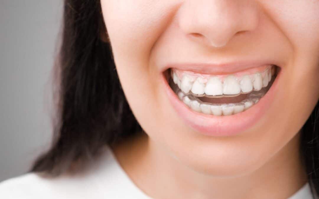 Is Invisalign Effective for Mild Orthodontic Problems?