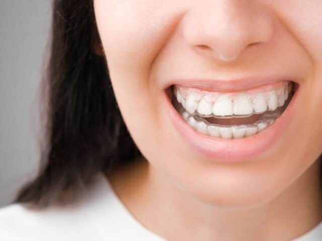 Is Invisalign Effective for Mild Orthodontic Problems?