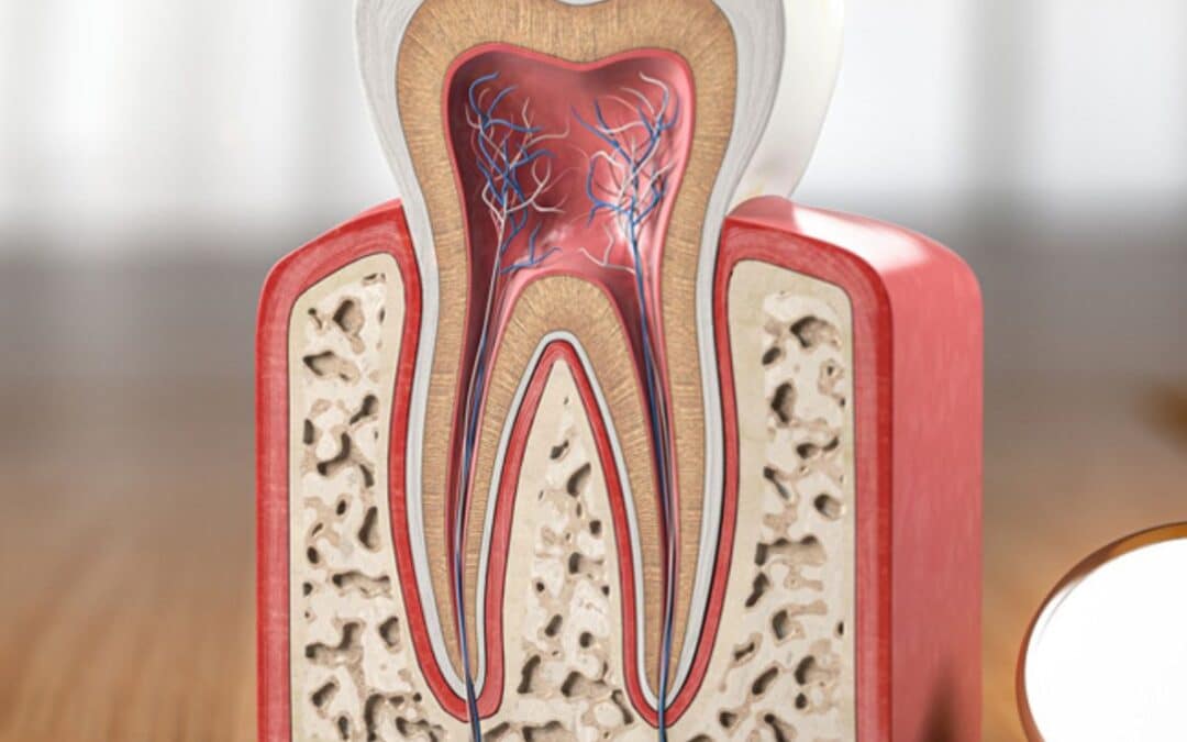 Do I Need a Root Canal After a Failed Filling?
