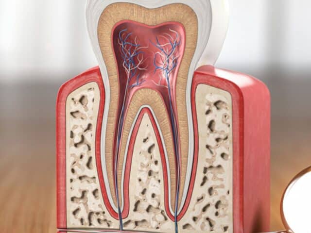 Do I Need a Root Canal After a Failed Filling?
