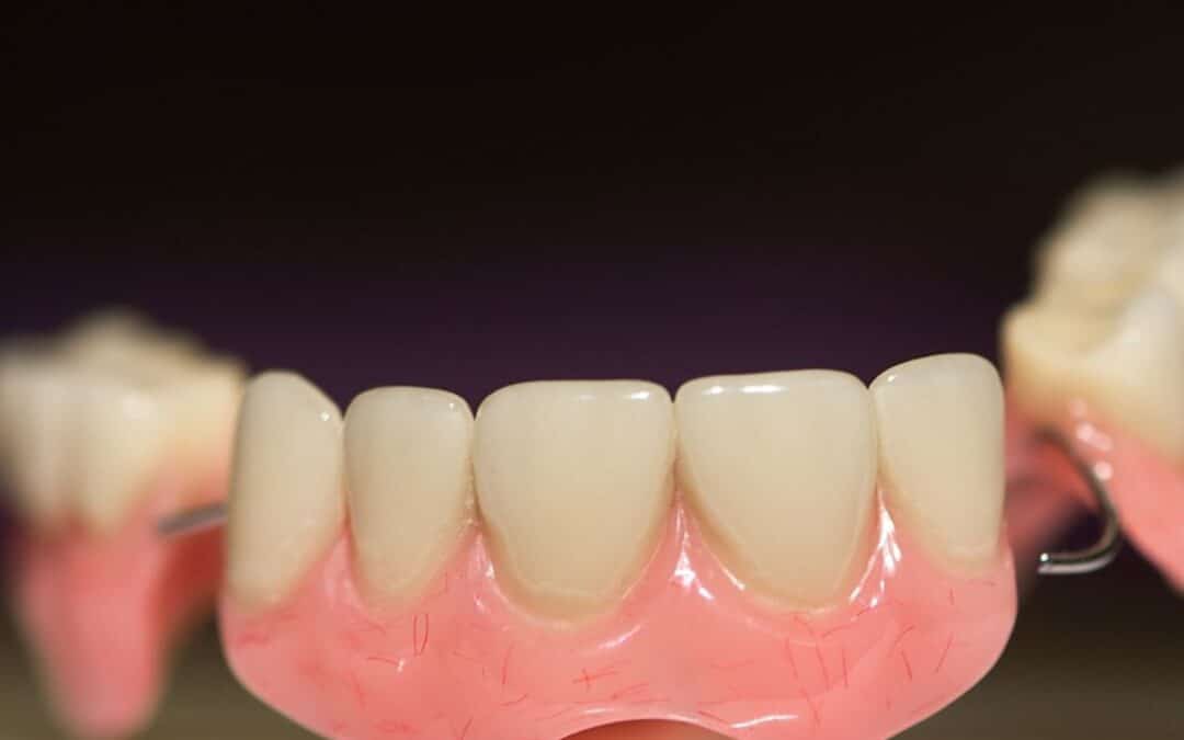 How Do I Prevent Sore Spots from Dentures?