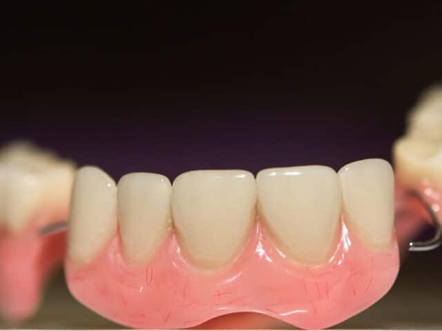 How Do I Prevent Sore Spots from Dentures?