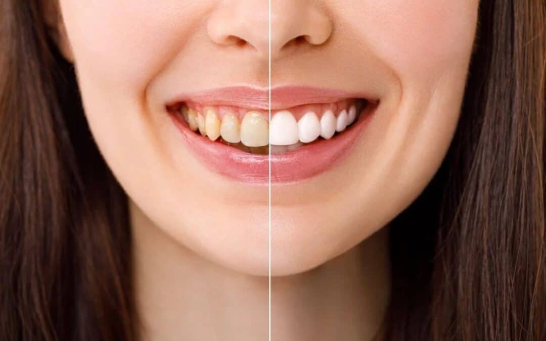 does-teeth-whitening-work-on-fluorosis-stains