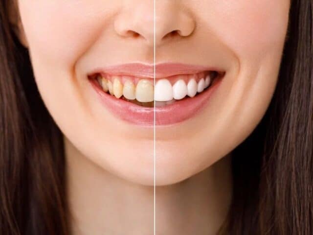 Does Teeth Whitening Work on Fluorosis Stains?