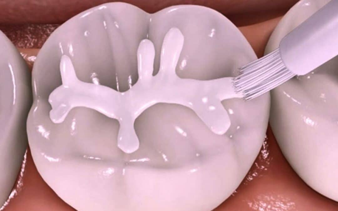 can-dental-sealants-be-placed-on-teeth-with-white-spots